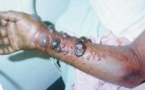 URGENT: Maladie Fièvre Crimée: Podor placé foyer chaud